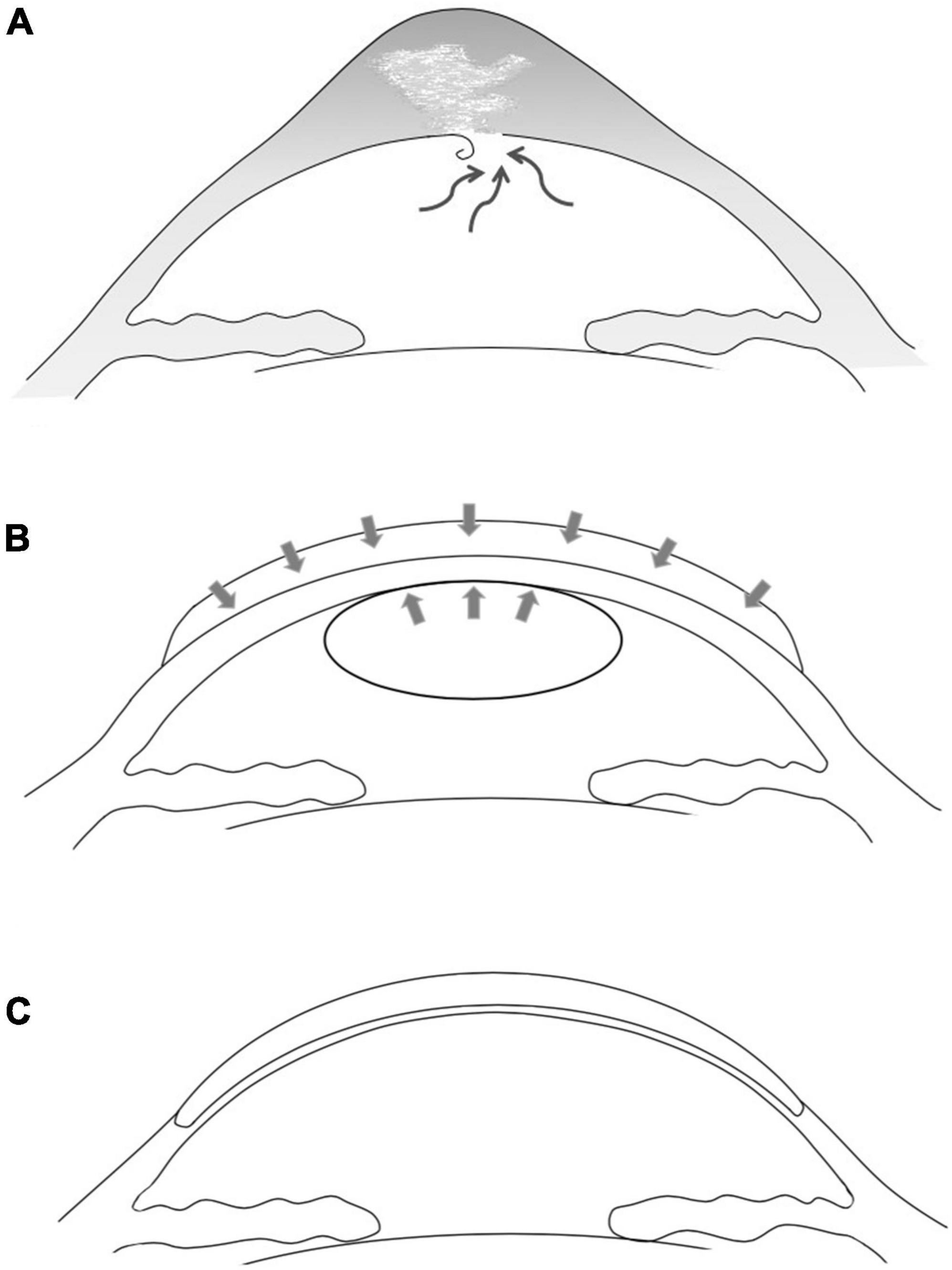 Deep anterior lamellar keratoplasty following thermokeratoplasty assisted epikeratophkia: A novel two-stage one-graft method to treat acute corneal hydrops